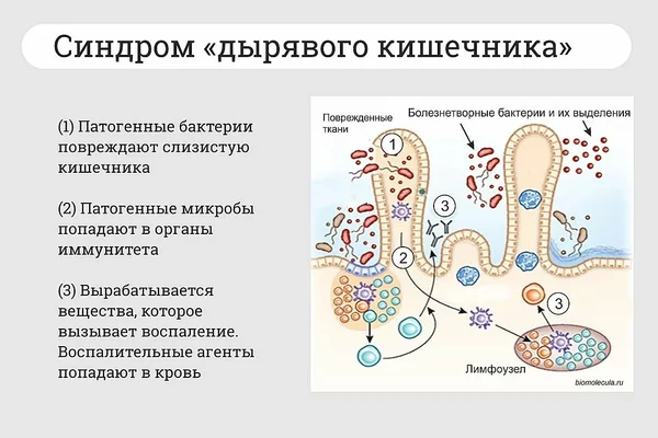 Синдром дырявого кишечника  - диагноз 21 века