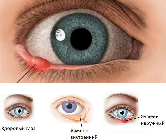 Как быстро вылечить ячмень на глазу