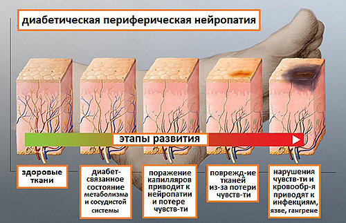 Диабетическая стопа - угроза жизни