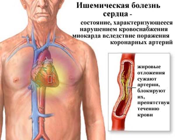 Ишемическая болезнь сердца: кто в зоне риска