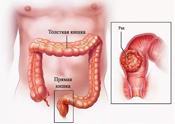Профилактика рака кишечника: советы проктолога, которые следует соблюдать каждому