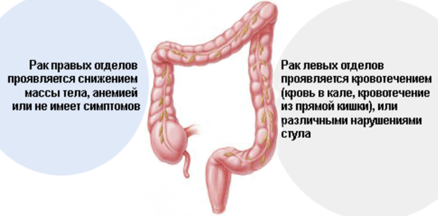 Профилактика рака кишечника: советы проктолога, которые следует соблюдать каждому