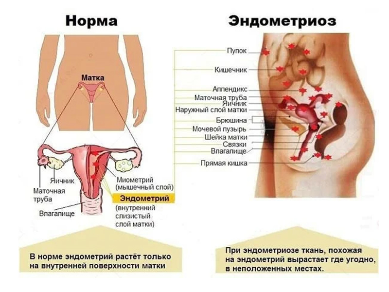 Эндометриоз: не игнорируйте боль внизу живота!