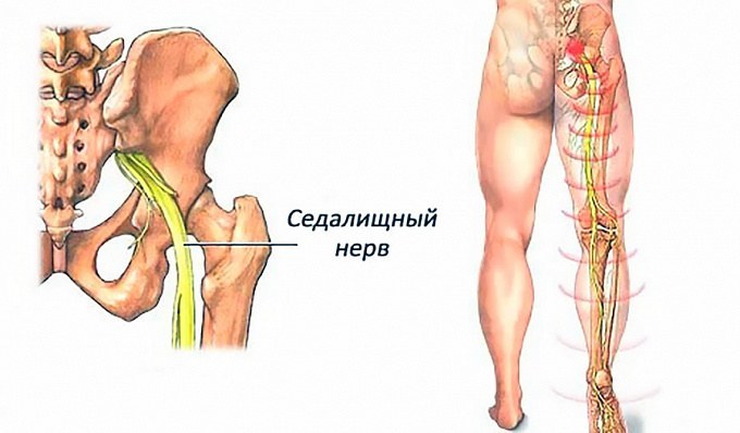 Защемление седалищного нерва: снимем боль за 1 минуту