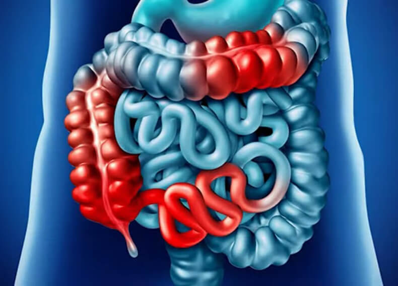 Как лечить воспалительные заболевания кишечника