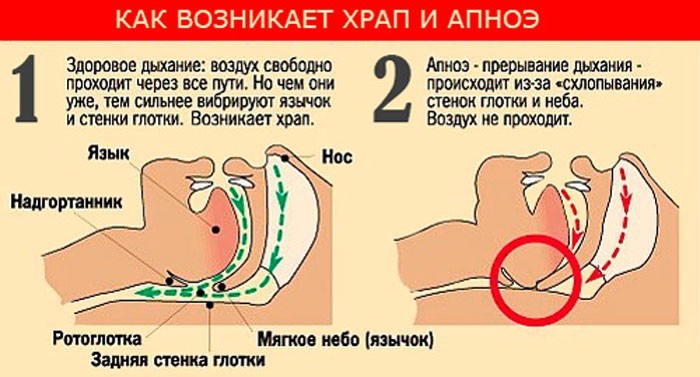 Как избавиться от храпа: простые упражнения по советам ЛОР-врача