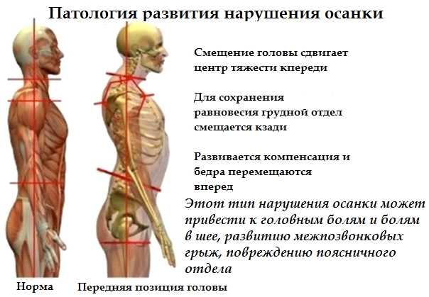 Болит спина? Лечите зубы!