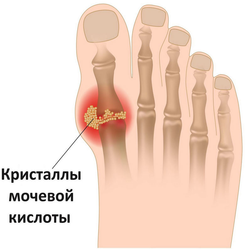 Подагра: что можно и чего нельзя есть