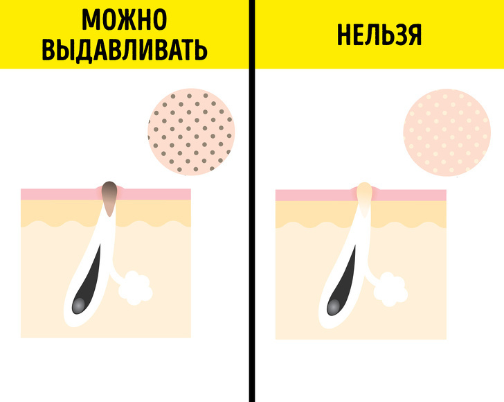 Сальные нити: от каких точек на лице НЕЛЬЗЯ избавляться