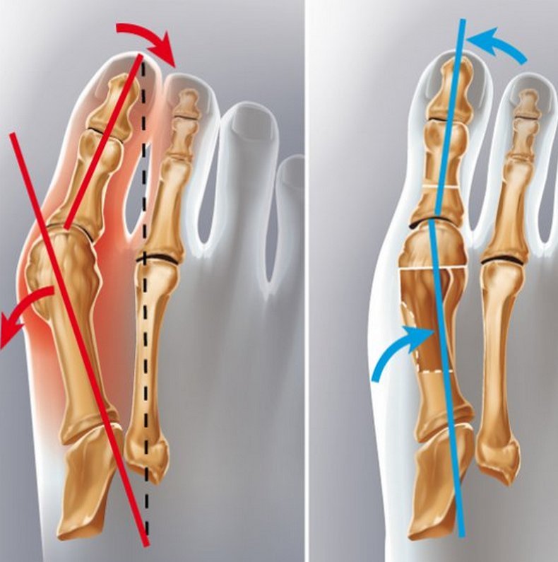 Вальгусная деформация стопы: упражнения и рекомендации ортопедов
