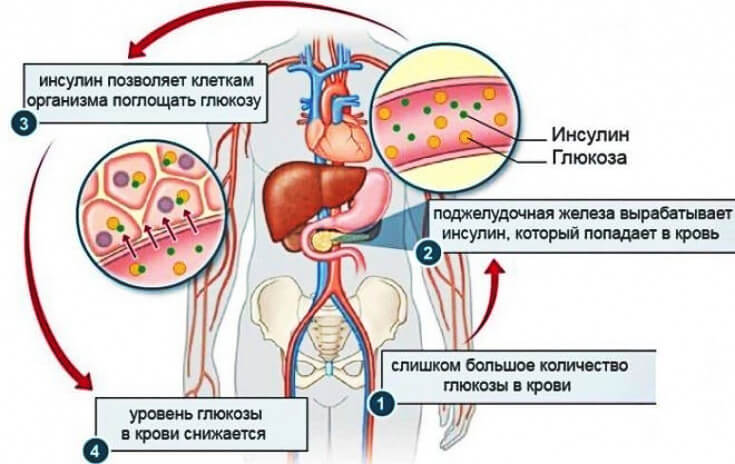 Настоящая пандемия - резистентность к инсулину