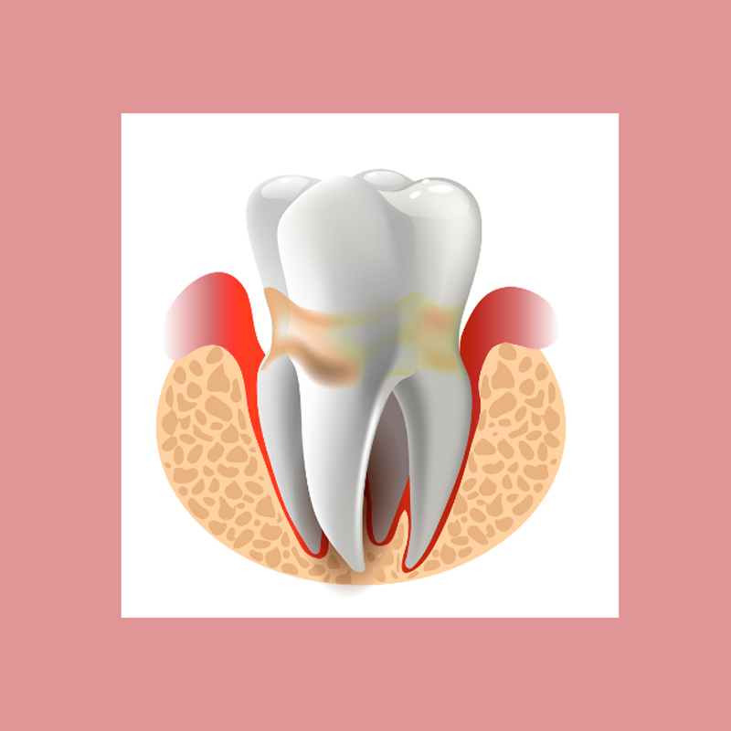 Пародонтоз: Как решить проблему самостоятельно