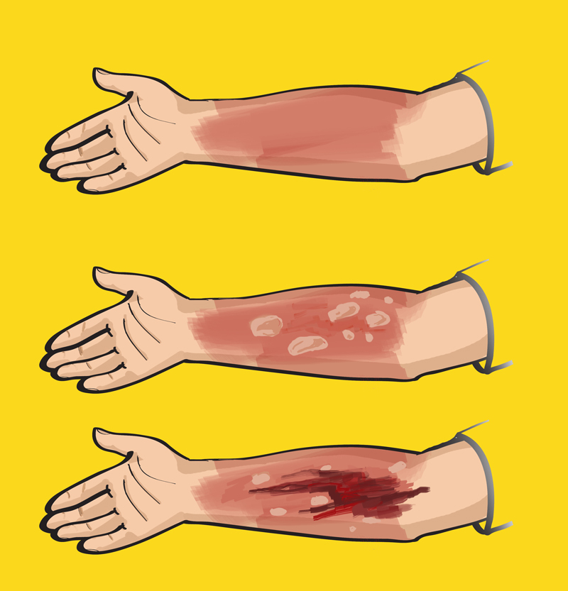 Первая помощь при ожогах кипятком, паром, маслом, утюгом, химическими средствами