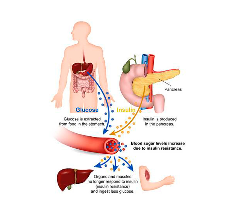 Инсулинорезистентность: как распознать и лечить