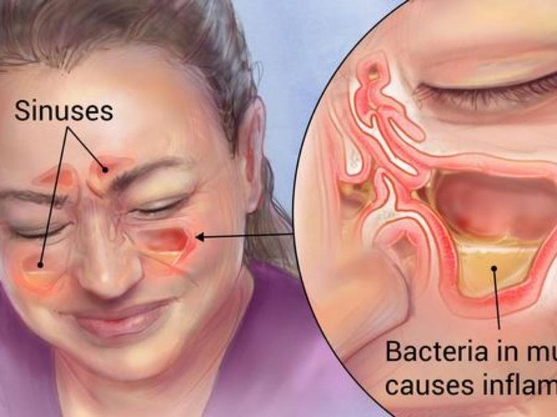 Лечение синусита
