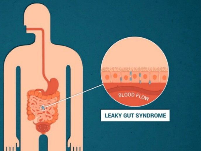 Как лечить синдром повышенной кишечной проницаемости?