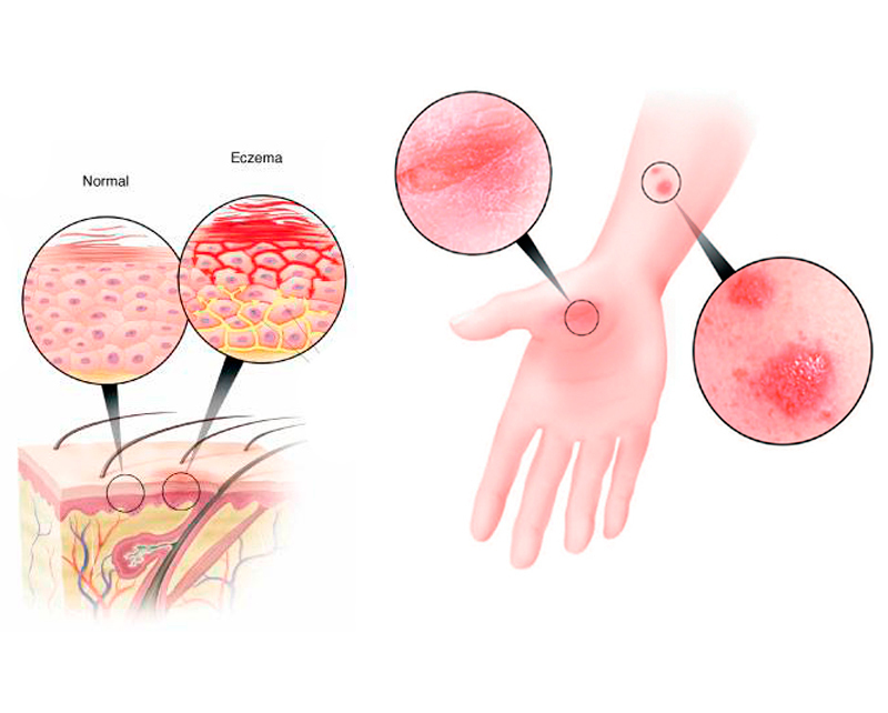 Экзема: советы дерматолога 