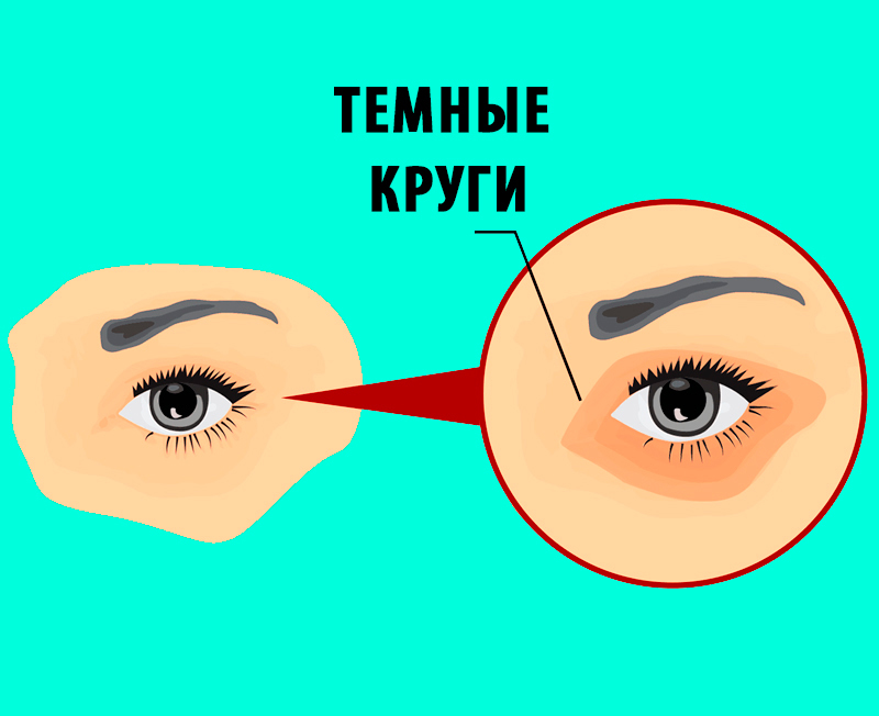 Как избавиться от темных кругов под глазами