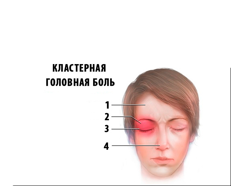 Кластерная головная боль: профилактика и лечение