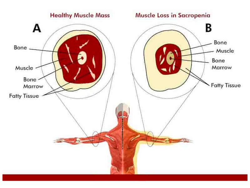 Саркопения: что нужно знать, чтобы не дать себе засохнуть