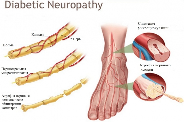 Добавки при диабетической нейропатии