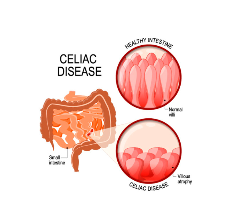 Целиакия: как лечить глютеновую болезнь