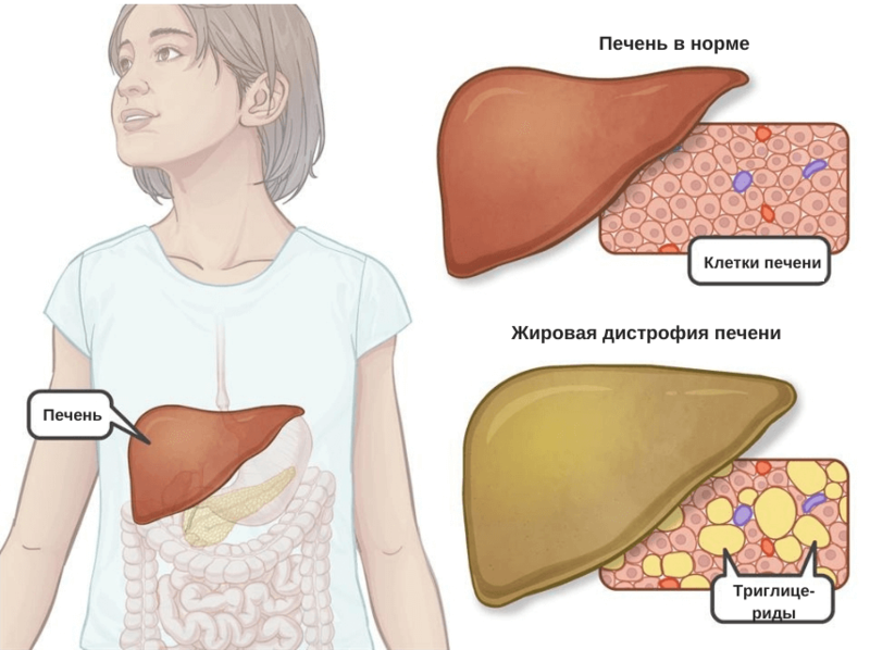 Поддержка при жировой болезни печени