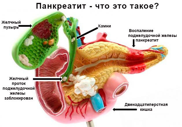 Что полезно знать про острый панкреатит