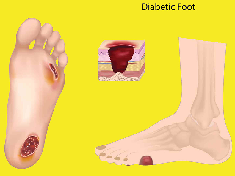 Что такое диабетическая стопа и как её лечат