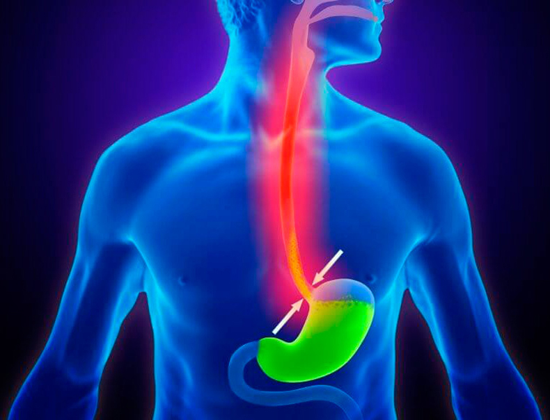 Кислотный рефлюкс: причины, симптомы и опасность