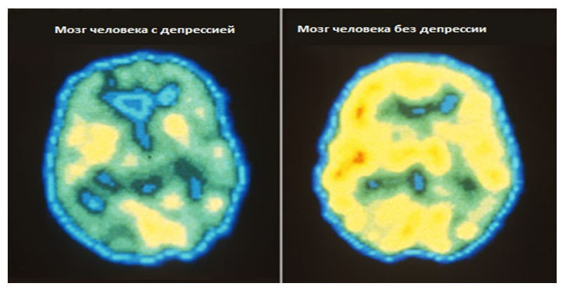 Депрессия — сложное психосоматическое расстройство