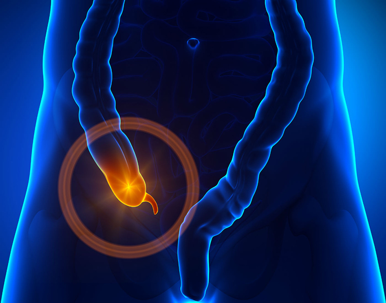 Как распознать признаки аппендицита