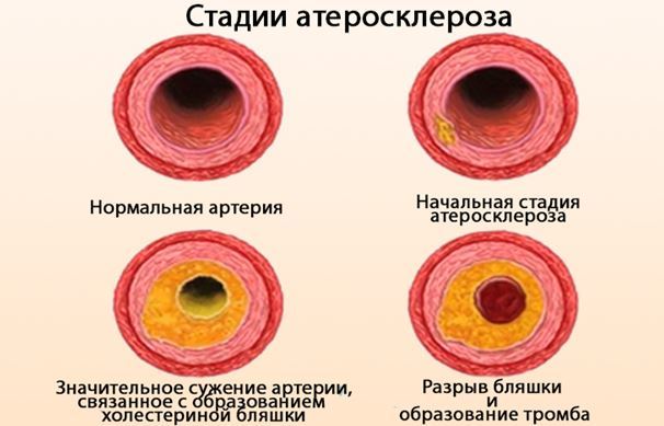 Атеросклероз сосудов головного мозга: что нужно знать