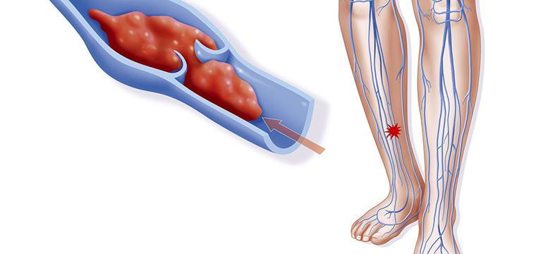 Тромбофлебит: симптомы, лечение и профилактика