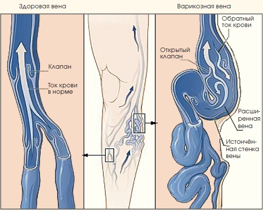 Варикозное расширение вен — психосоматика и лечение 