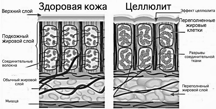 Как избавиться от целлюлита: что есть, на какие процедуры ходить и какие упражнения делать